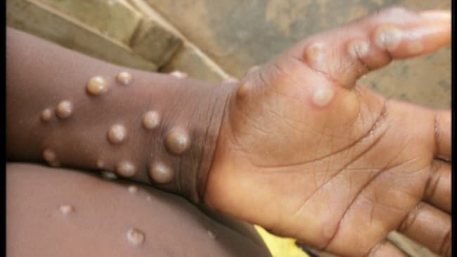 Mpox: WHO Declares End To Health Emergency