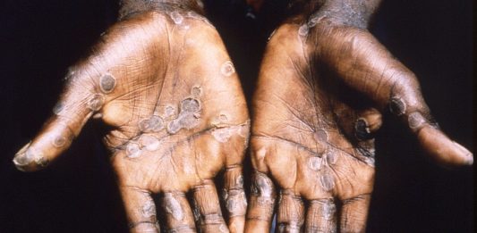 BREAKING: WHO Says Monkeypox Is Now A Global Outbreak