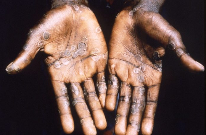 BREAKING: WHO Says Monkeypox Is Now A Global Outbreak