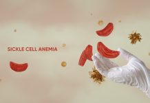 Nigeria tops global sickle cell burden with 1.5 million affected children — Lancet study