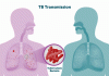 World Health Assembly approves new global tuberculosis strategy beyond 2030